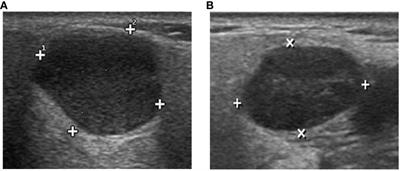 Deep learning based ultrasound analysis facilitates precise distinction between parotid pleomorphic adenoma and Warthin tumor